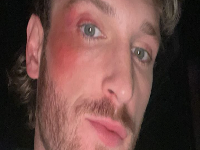 Logan Paul Gets Punched in Face by Rival, Shows off Bruise